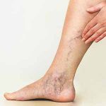 Examination of varicose veins on the womans legs
