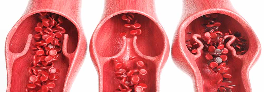 Chronic Venous Insufficiency Treatment Muto Vein Center